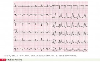 面向急诊科医生的四种高危心肌梗死心电图形态精要与识别指引