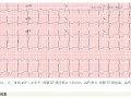 急性冠状动脉闭塞性心肌梗死六种STEMI同等高危心电图征象解析