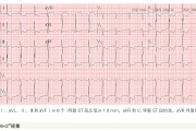急性冠状动脉闭塞性心肌梗死六种STEMI同等高危心电图征象解析