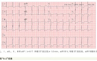 急性冠状动脉闭塞性心肌梗死六种STEMI同等高危心电图征象解析