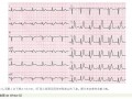 面向急诊科医生的四种高危心肌梗死心电图形态精要与识别指引