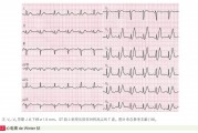 面向急诊科医生的四种高危心肌梗死心电图形态精要与识别指引
