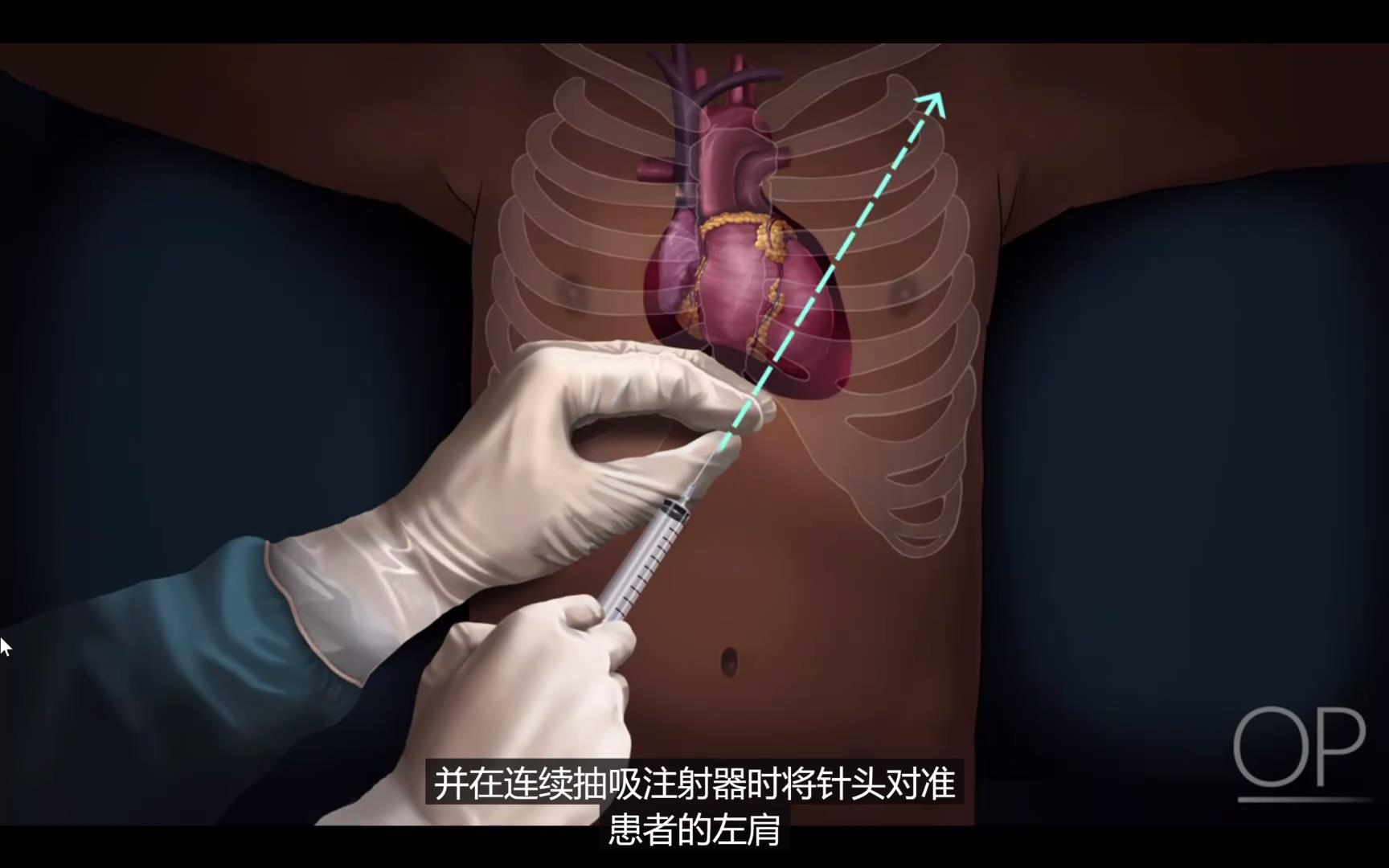 急诊紧急心包穿刺术 急诊紧急心包穿刺术