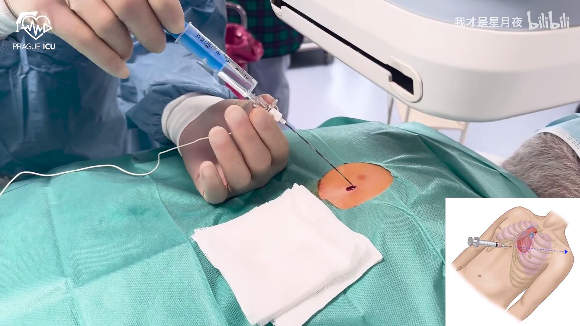 心包穿刺术Pericardiocentesis 心包穿刺术Pericardiocentesis