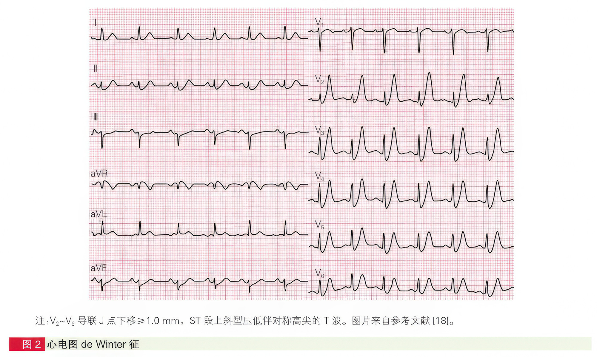 面向急诊科医生的四种高危心肌梗死心电图形态精要与识别指引-第1张图片-医海无涯