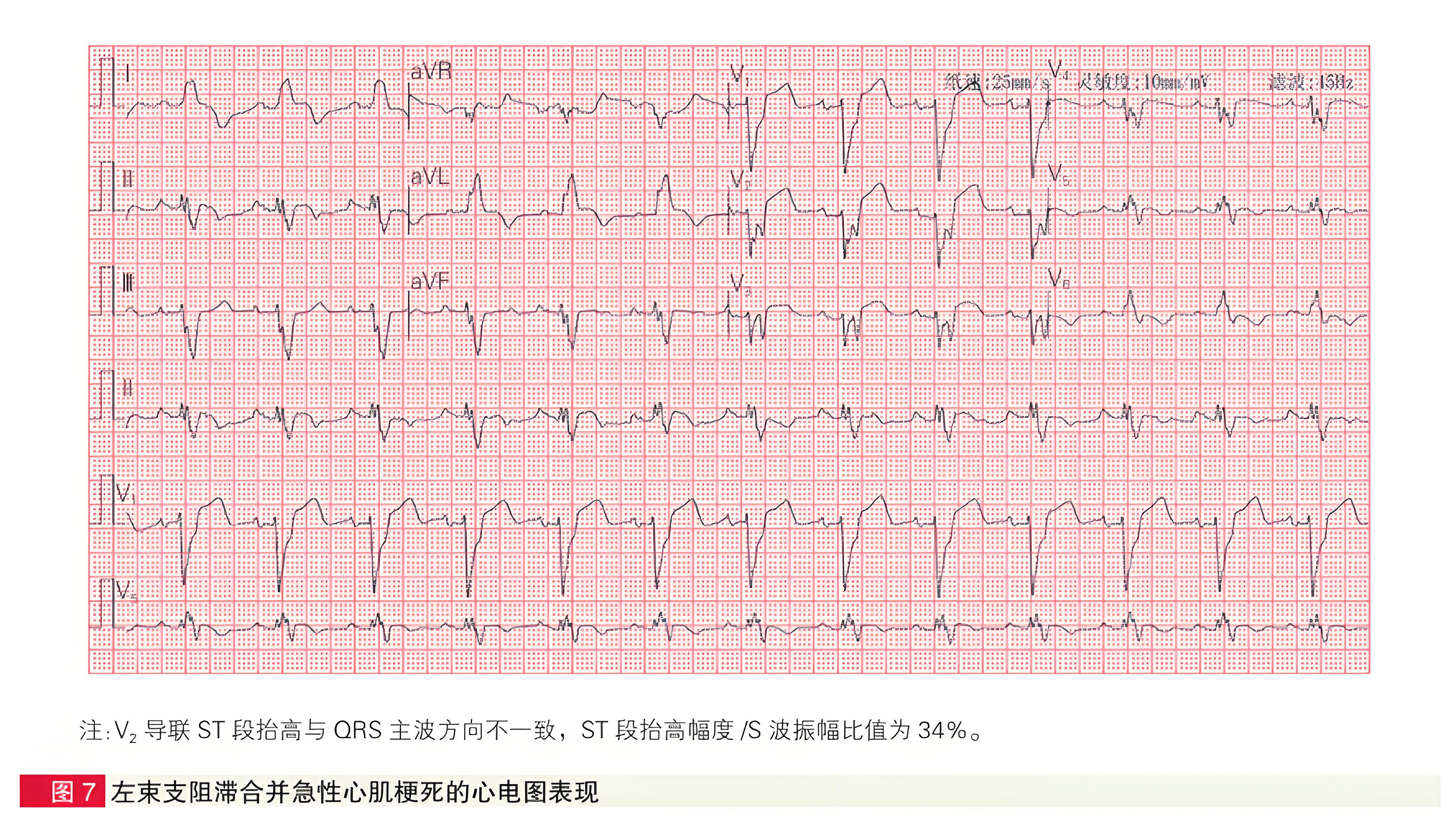 急性冠状动脉闭塞性心肌梗死六种STEMI同等高危心电图征象解析-第7张图片-医海无涯