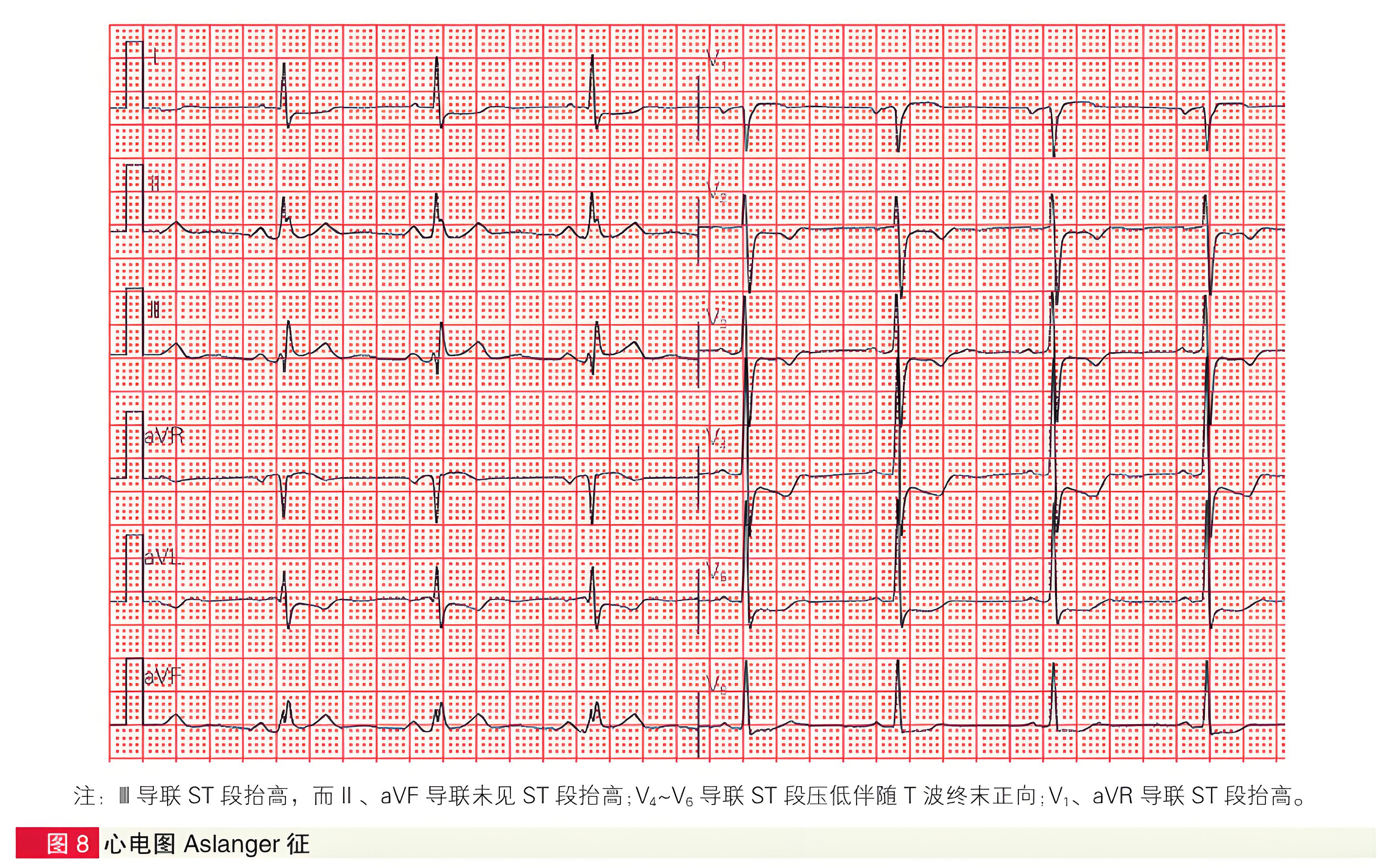 急性冠状动脉闭塞性心肌梗死六种STEMI同等高危心电图征象解析-第8张图片-医海无涯