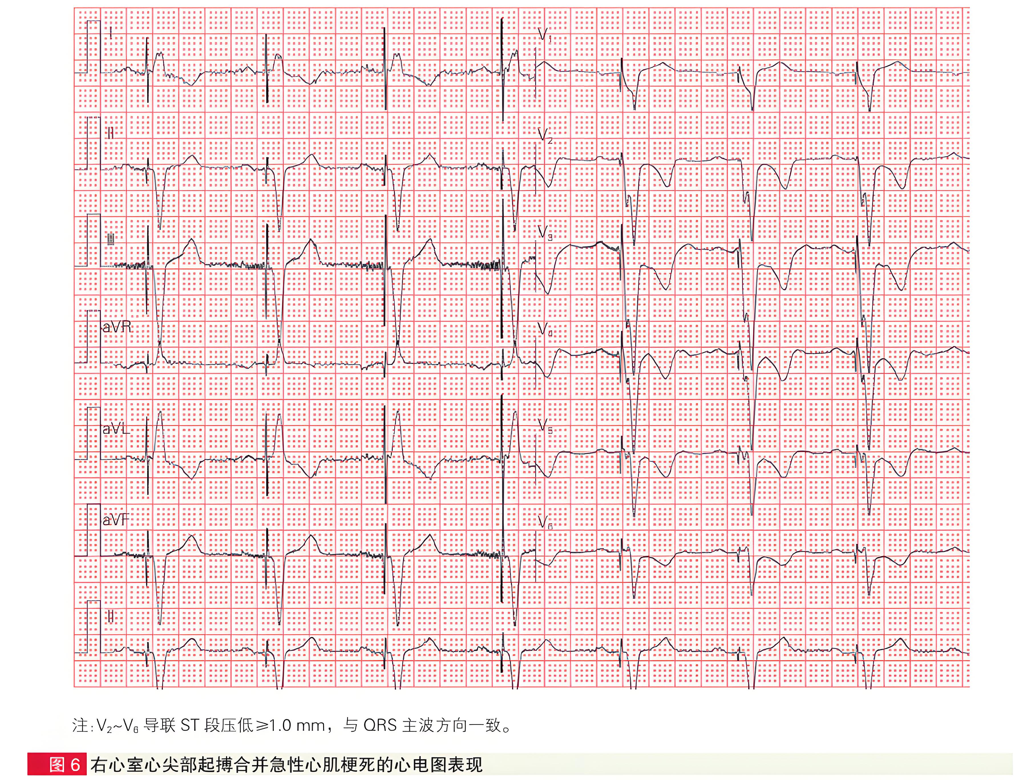 急性冠状动脉闭塞性心肌梗死六种STEMI同等高危心电图征象解析-第6张图片-医海无涯