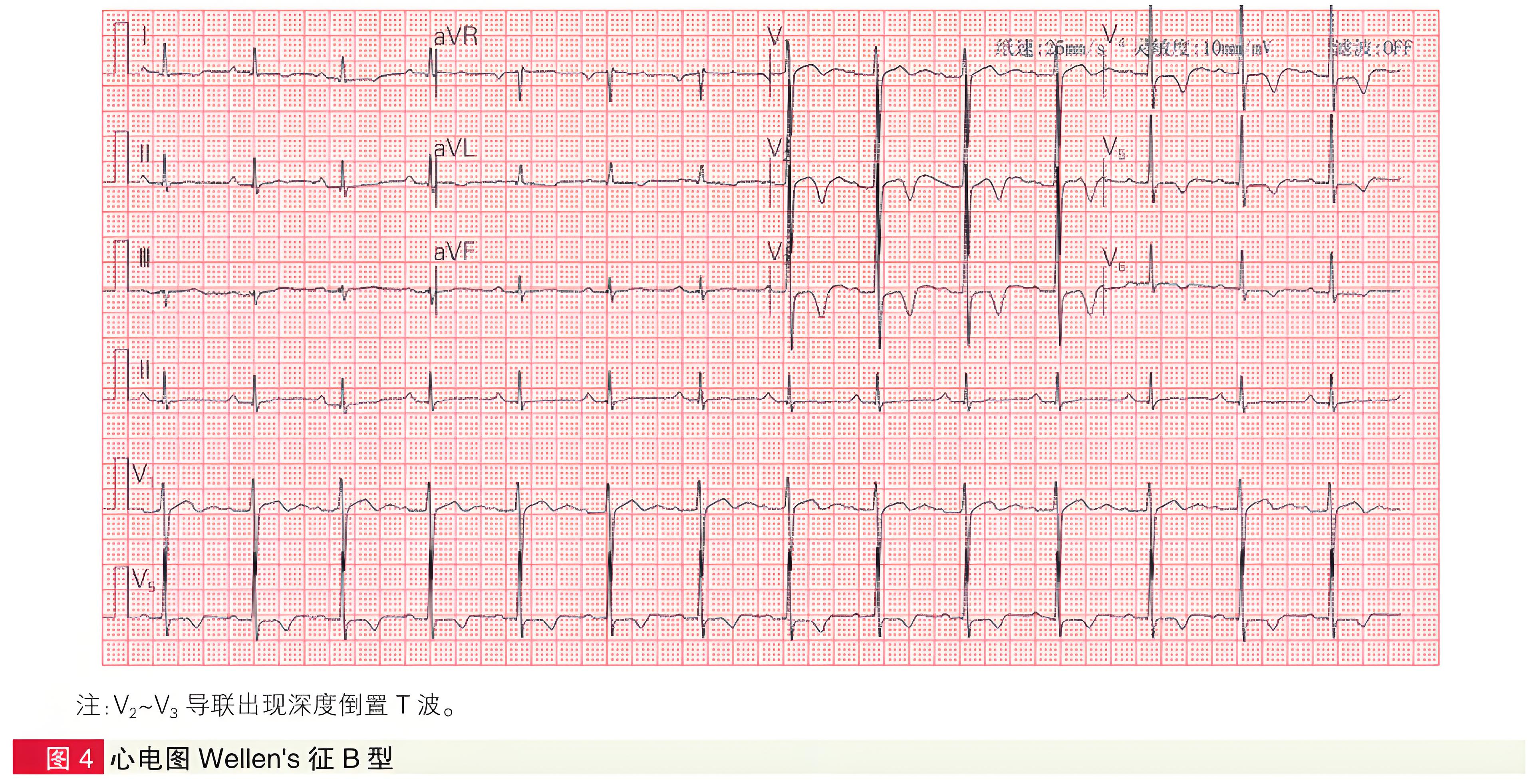 面向急诊科医生的四种高危心肌梗死心电图形态精要与识别指引-第2张图片-医海无涯