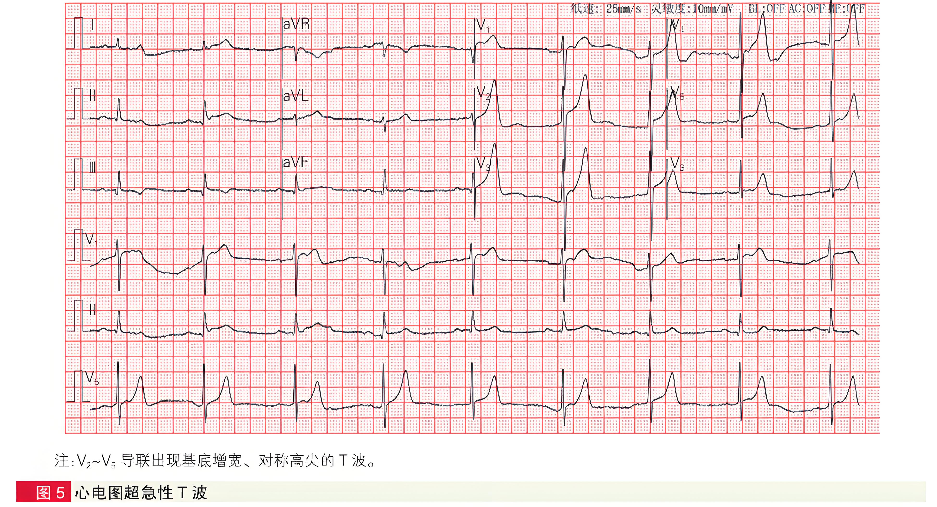 急性冠状动脉闭塞性心肌梗死六种STEMI同等高危心电图征象解析-第5张图片-医海无涯