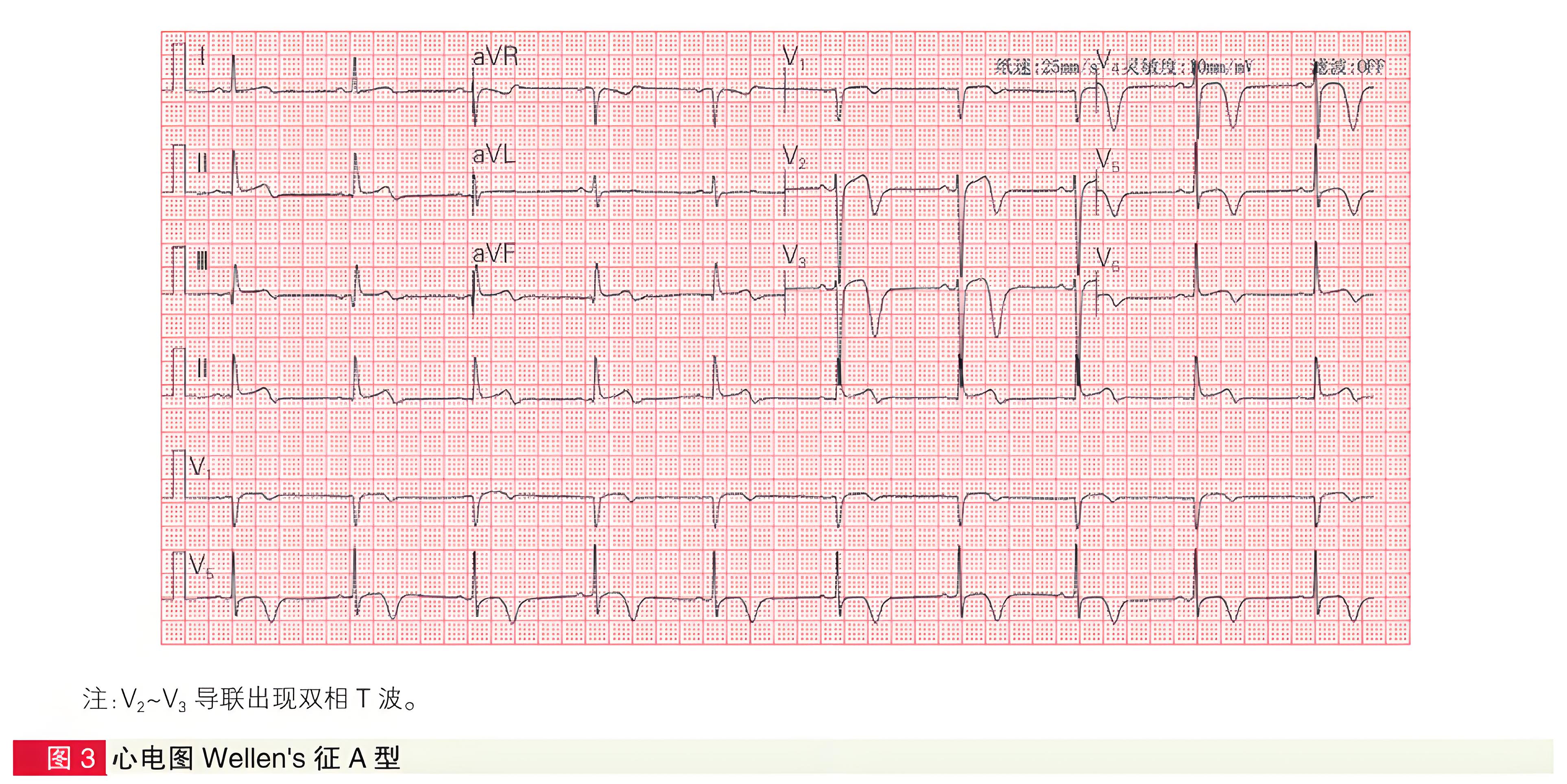 面向急诊科医生的四种高危心肌梗死心电图形态精要与识别指引-第3张图片-医海无涯