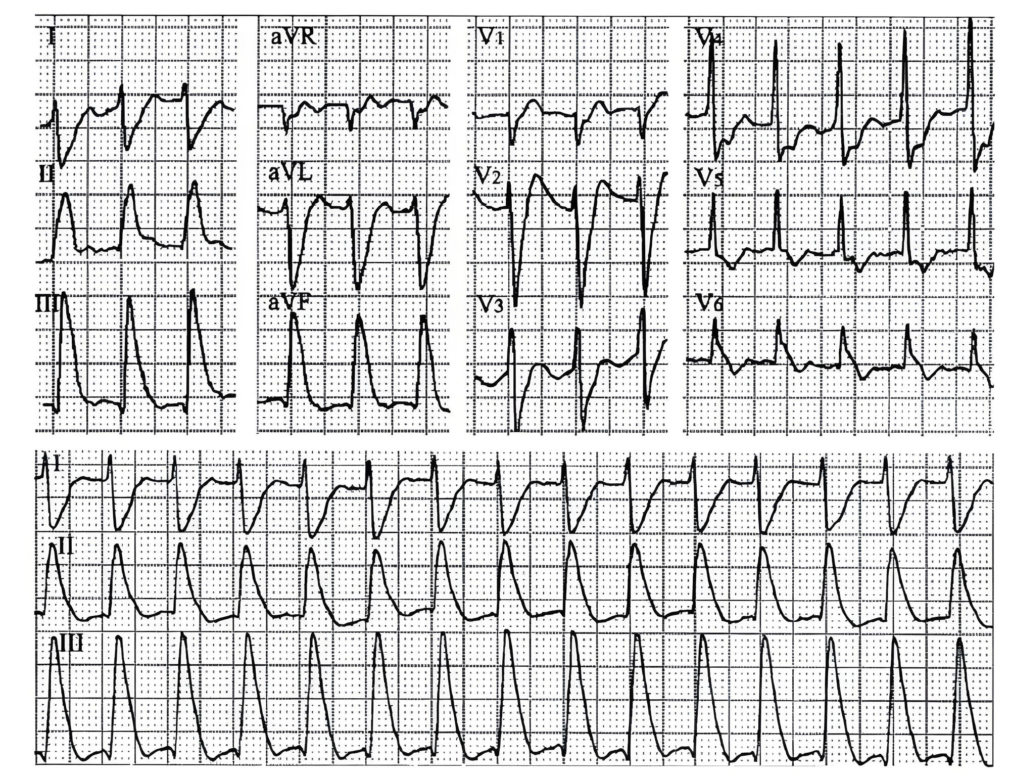 面向急诊科医生的四种高危心肌梗死心电图形态精要与识别指引-第4张图片-医海无涯
